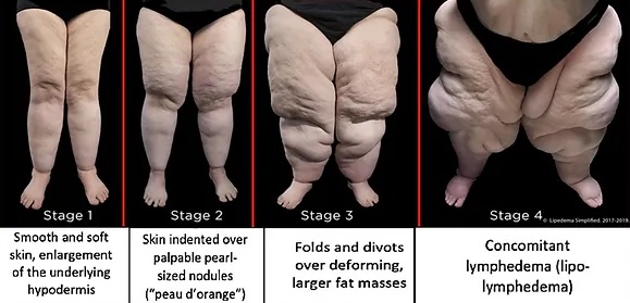 Lipedema is a chronic disorder of fat metabolism and distribution.